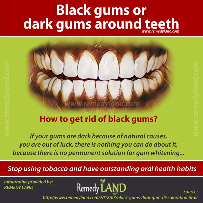 gums gum dark discoloration teeth around disease cause periodontal necrotizing remedy acute